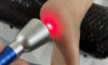 Laser Therapy: A High Intensity Treatment Option