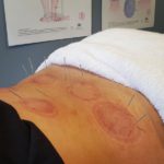 Sports Recovery Acupuncture: Unlock 6 Key Benefits