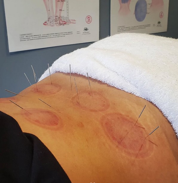 Sports Recovery Acupuncture: Unlock 6 Key Benefits