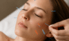 Cosmetic Acupuncture Disadvantages to Keep in Mind
