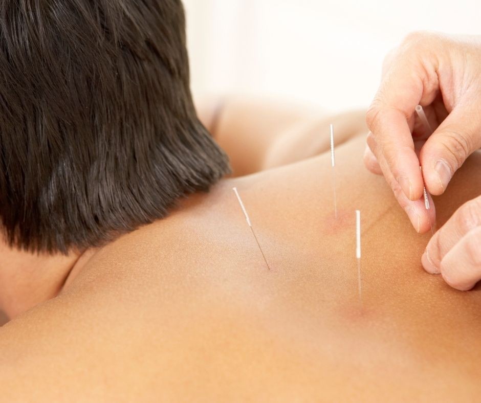 Acupuncture and Cupping for Optimal Sports Recovery