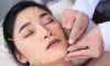 Cosmetic Acupuncture: Essential Disadvantages to Know